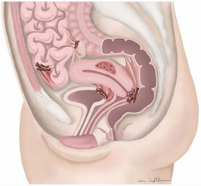 Endomitritis