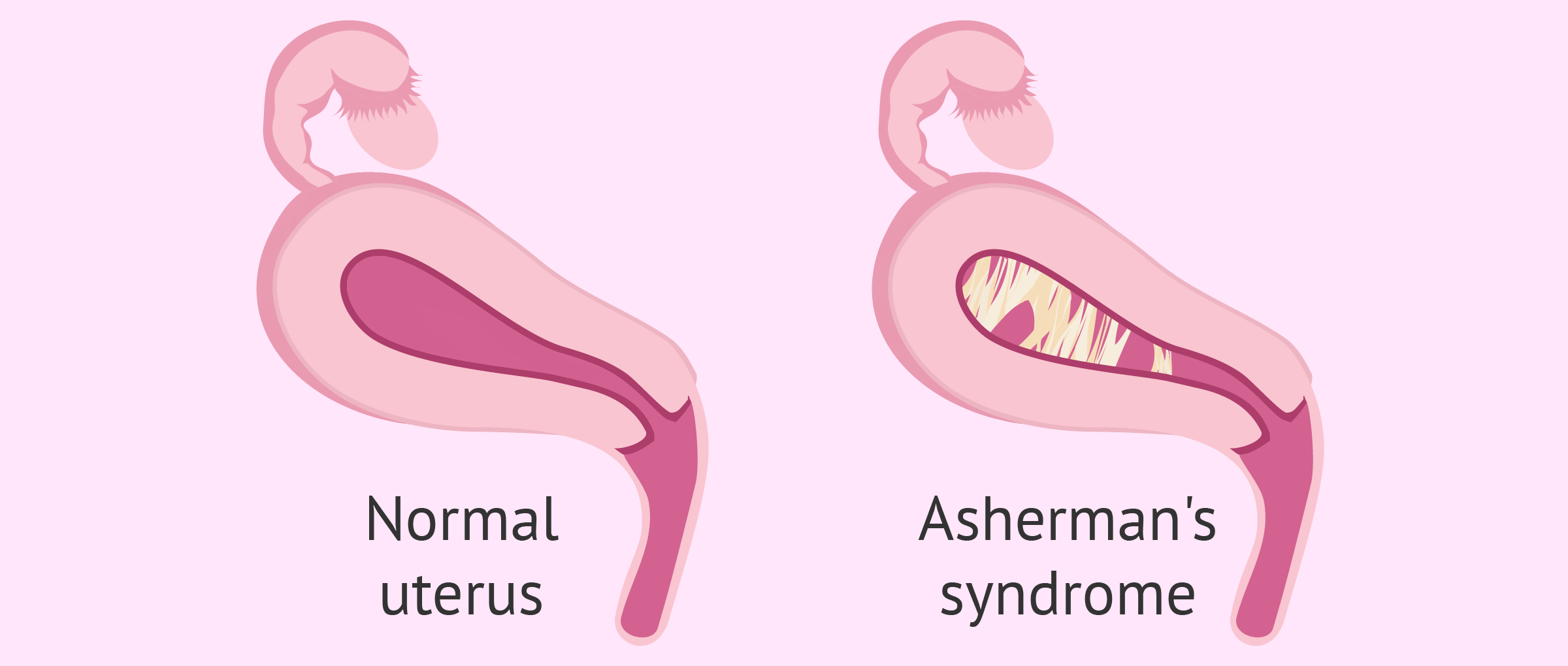 Normal Uterus Vs Uterine Adhesions